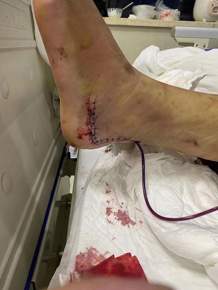 民警抓捕嫌犯受伤通常会被奖励,并记相应等级的功劳,如果因此获得社会