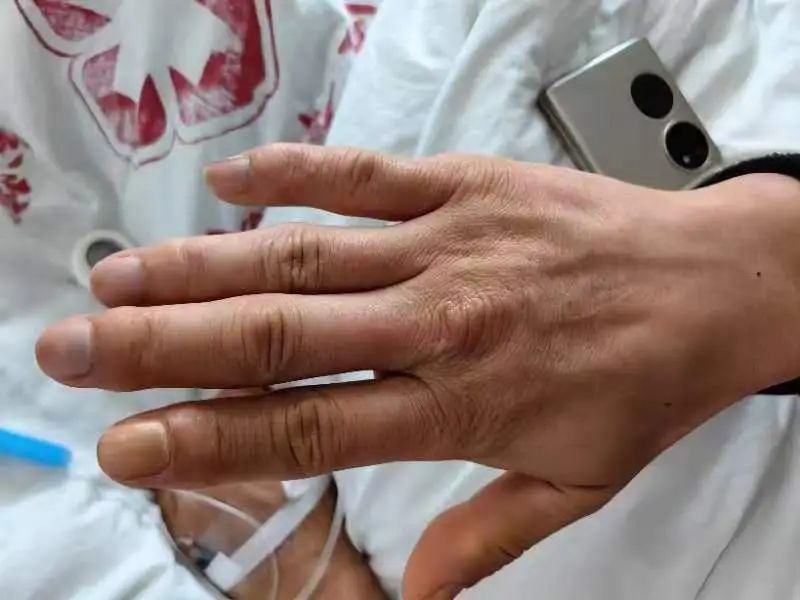 揭秘肢端肥大症:高血糖背后的罕见内分泌疾病丨贤医健康说