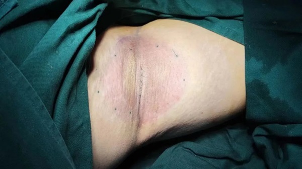 围观"有味道"的手术,治疗五花八门的腋臭|第医线