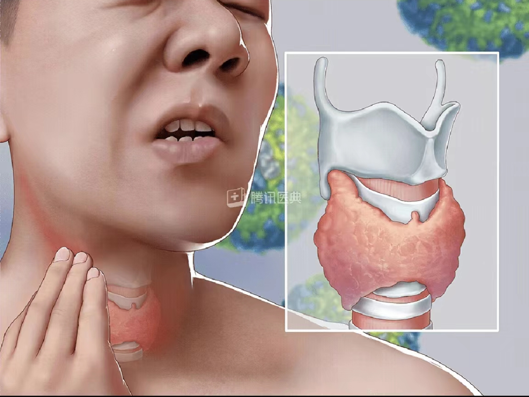 亚急性甲状腺炎(图源:腾讯医典)