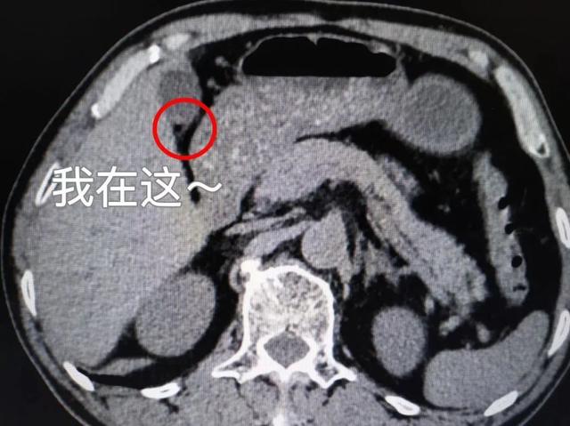 2胆固醇含量70%以上胆固醇类结石1首先我们了解一下胆囊结石的分型