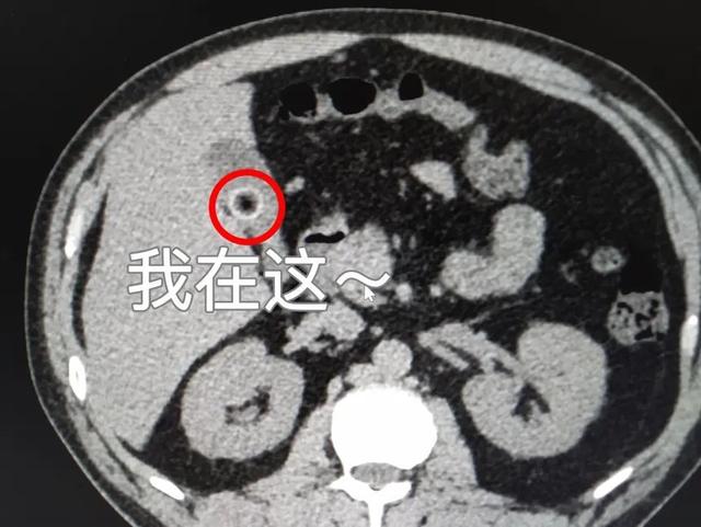 急性阑尾炎报告单b超图片