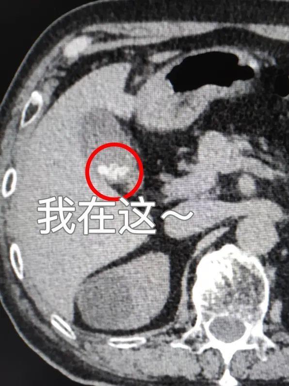 b超报告说有胆结石,为啥 ct检查又说没有呢?让我们"医"探究竟