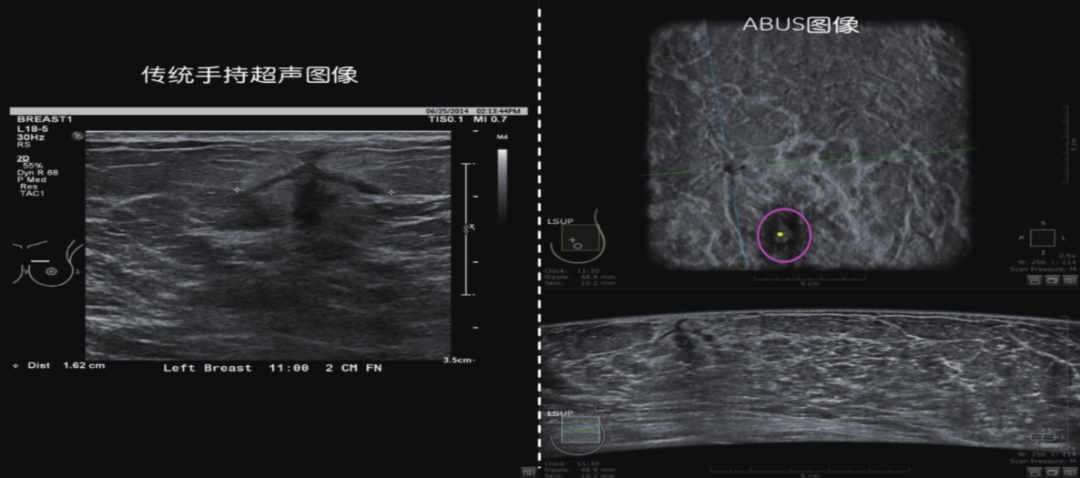 重磅来袭|华大基因自动化乳腺超声移动车全新上市