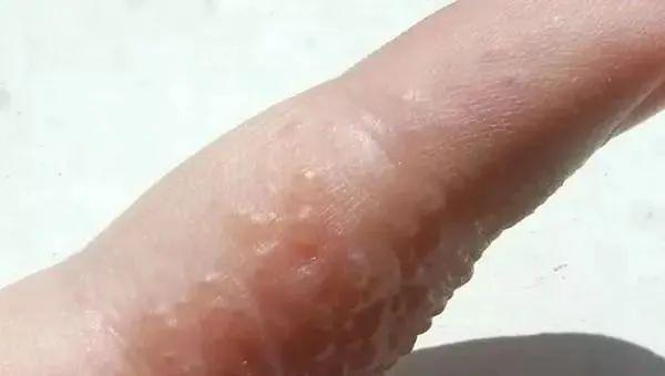 夏天到了,手上长的透明小水泡是什么?
