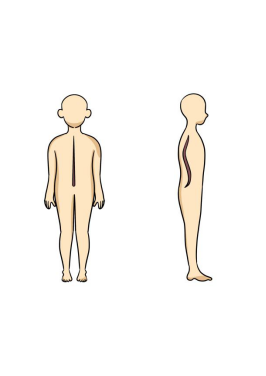 要做"正直"少年,专家提醒关注儿童青少年脊柱侧弯