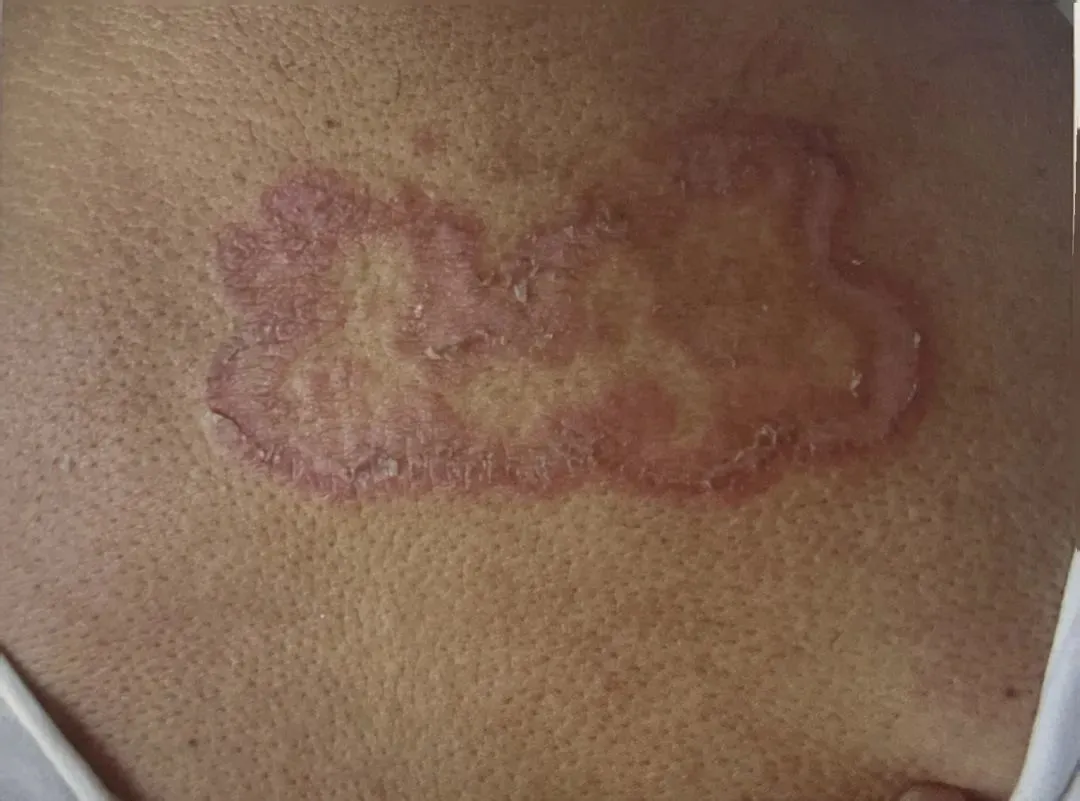 股癣,灰指甲,脚气……被真菌感染后不及时治疗会怎样?