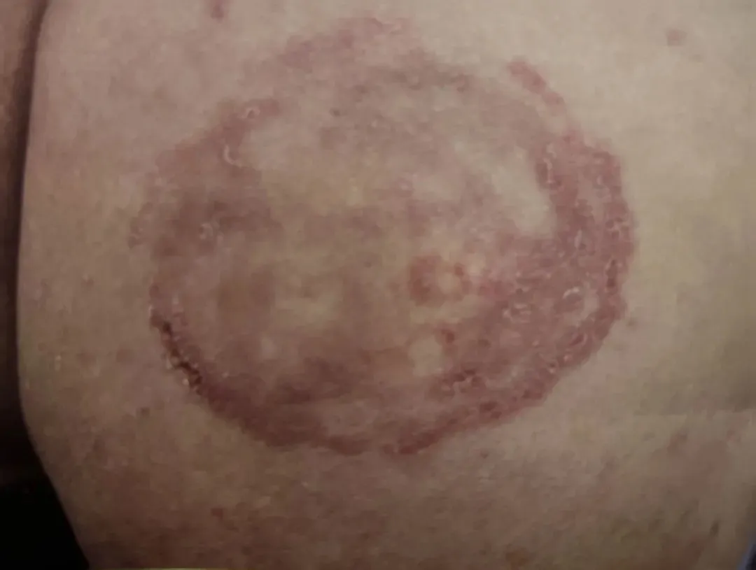 股癣,灰指甲,脚气……被真菌感染后不及时治疗会怎样?