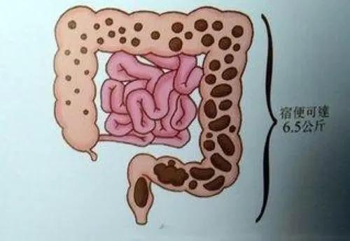 人的肠道有5~8米,弯弯曲曲都是褶皱,肠道垃圾排不出去,就会形成宿便