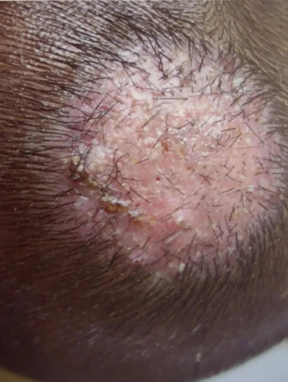 股癣,灰指甲,脚气……被真菌感染后不及时治疗会怎样?