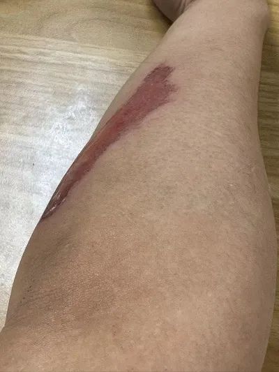 周先生腿部的伤势严重