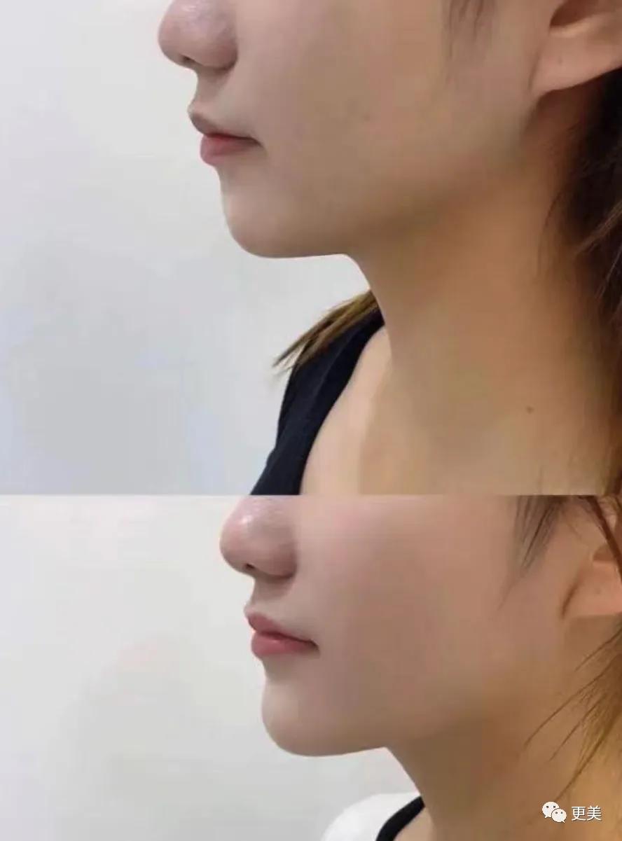 套牢大哥的高干文女主脸,打了多少童颜针啊?