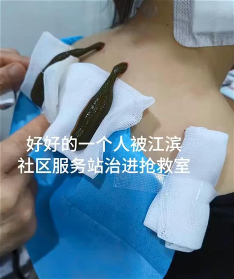 黑龙江一女子称用水蛭治疗颈椎病后休克,官方:已受理该案件