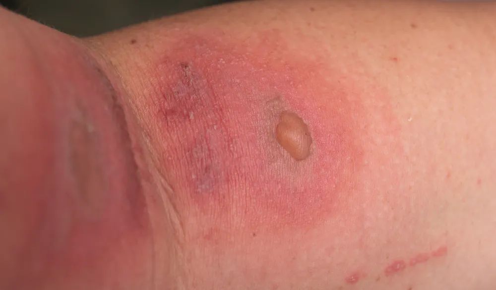 隐翅虫皮炎 图源:站酷海洛