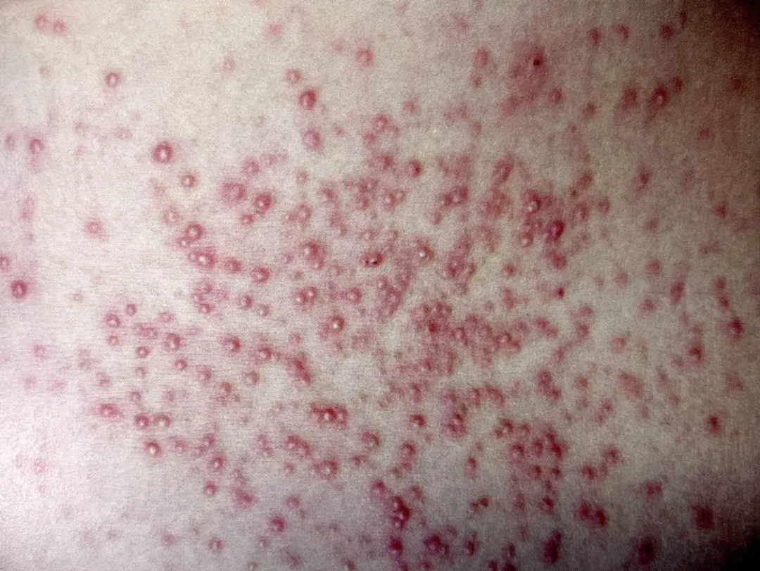 前胸后背,头皮,私处反复长红疙瘩,小心是毛囊炎作祟