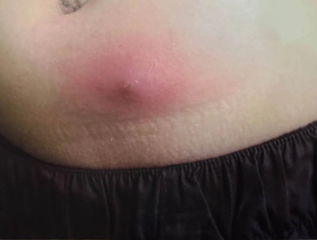 前胸后背,头皮,私处反复长红疙瘩,小心是毛囊炎作祟