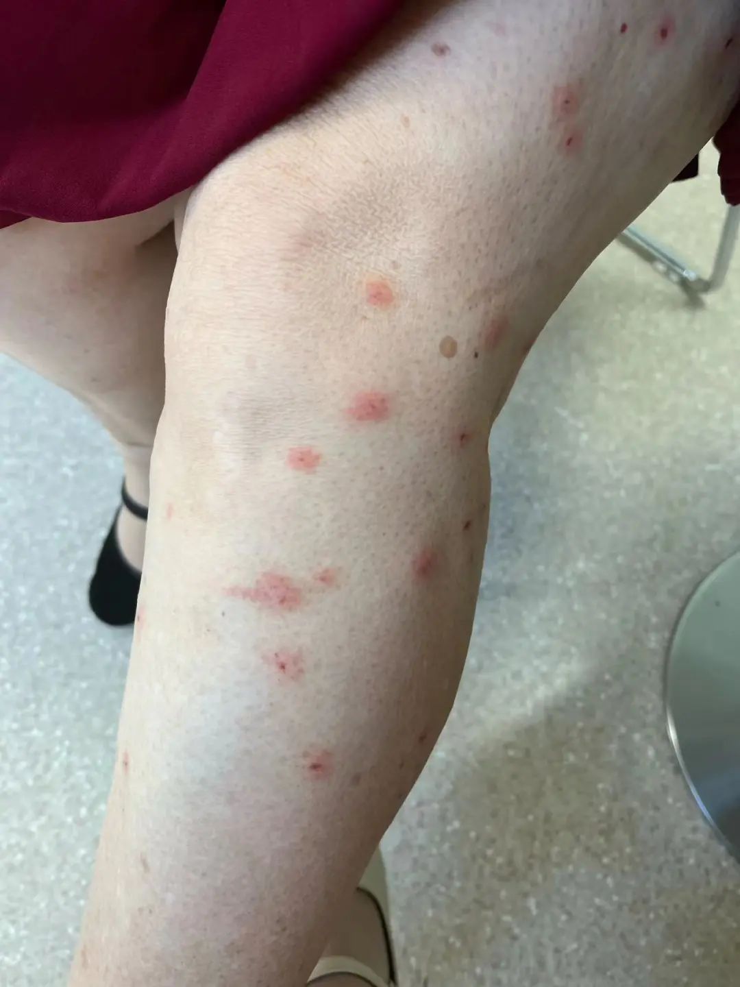 卢淑娇医生温馨提示,被子衣服容易滋生螨虫