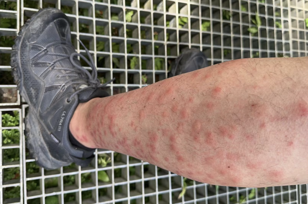 这种夏季常见虫子比蚊子还毒