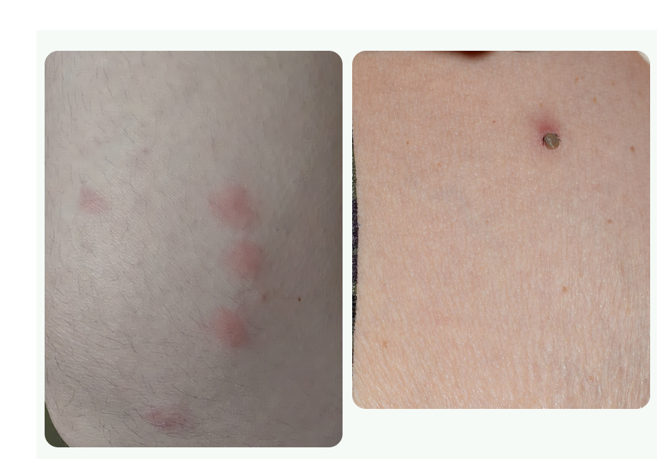 蚊虫叮咬留下的伤痕.