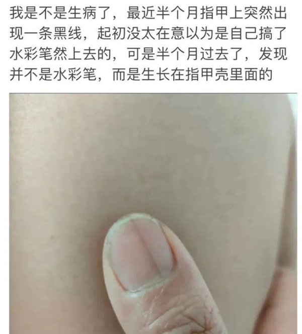 指甲出现一条黑线 别不当回事!可能是癌变
