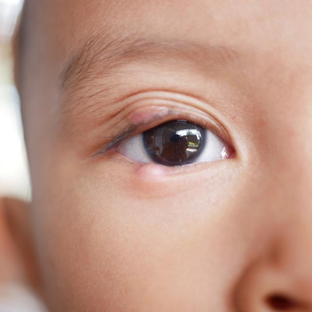 麦粒肿有哪些症状?