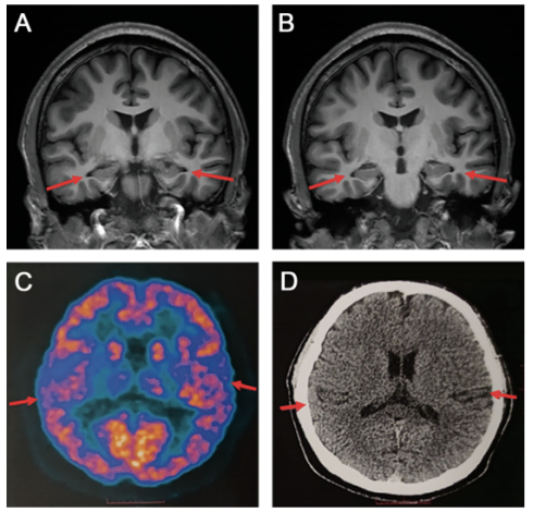 患者脑部磁共振(mri)结果图
