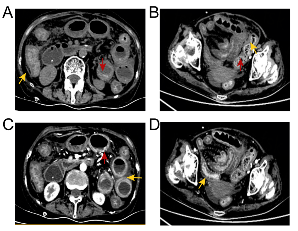 患者接受"肠梗阻"的治疗方案,在治疗阶段中腹胀加重,病情进一步恶化.