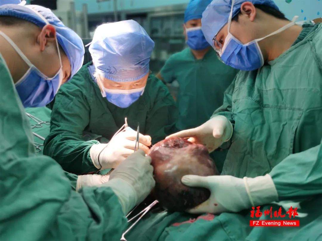 吴典明为患儿切除巨大肿瘤