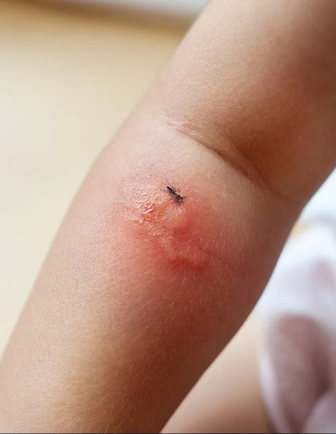 炭疽乙类甲管,精准检测助力多种病症的有效诊疗