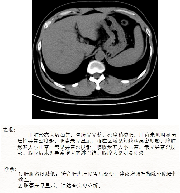 肝包膜下积液ct图片图片