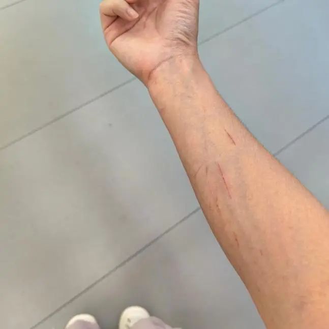 林子的手臂被保温袋边缘划伤.受访者供图