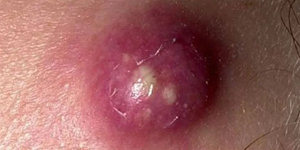 一种"红包"又痛又肿:硬挤还很危险