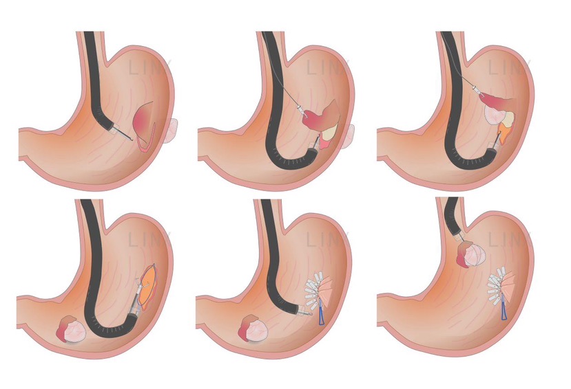图2 内镜下切除胃黏膜下肿瘤（感谢：林新林绘制插图）