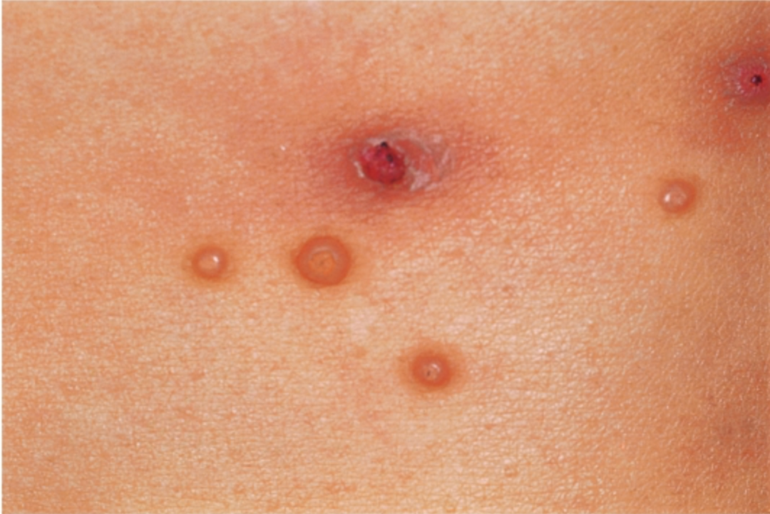 传染性软疣_新浪财经_新浪网