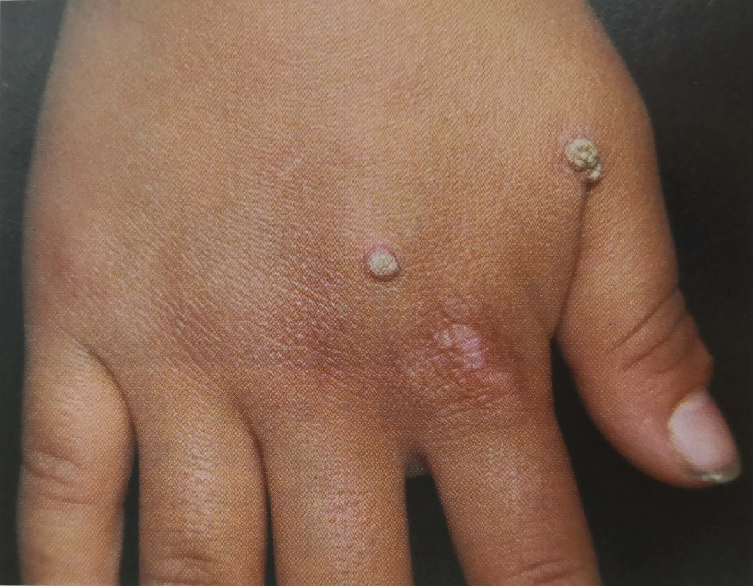 寻常疣图片来源:何春涤,张学军主编《皮肤性病学图谱》