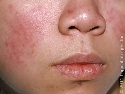 号称"不死癌症"的红斑狼疮:真不是绝症!