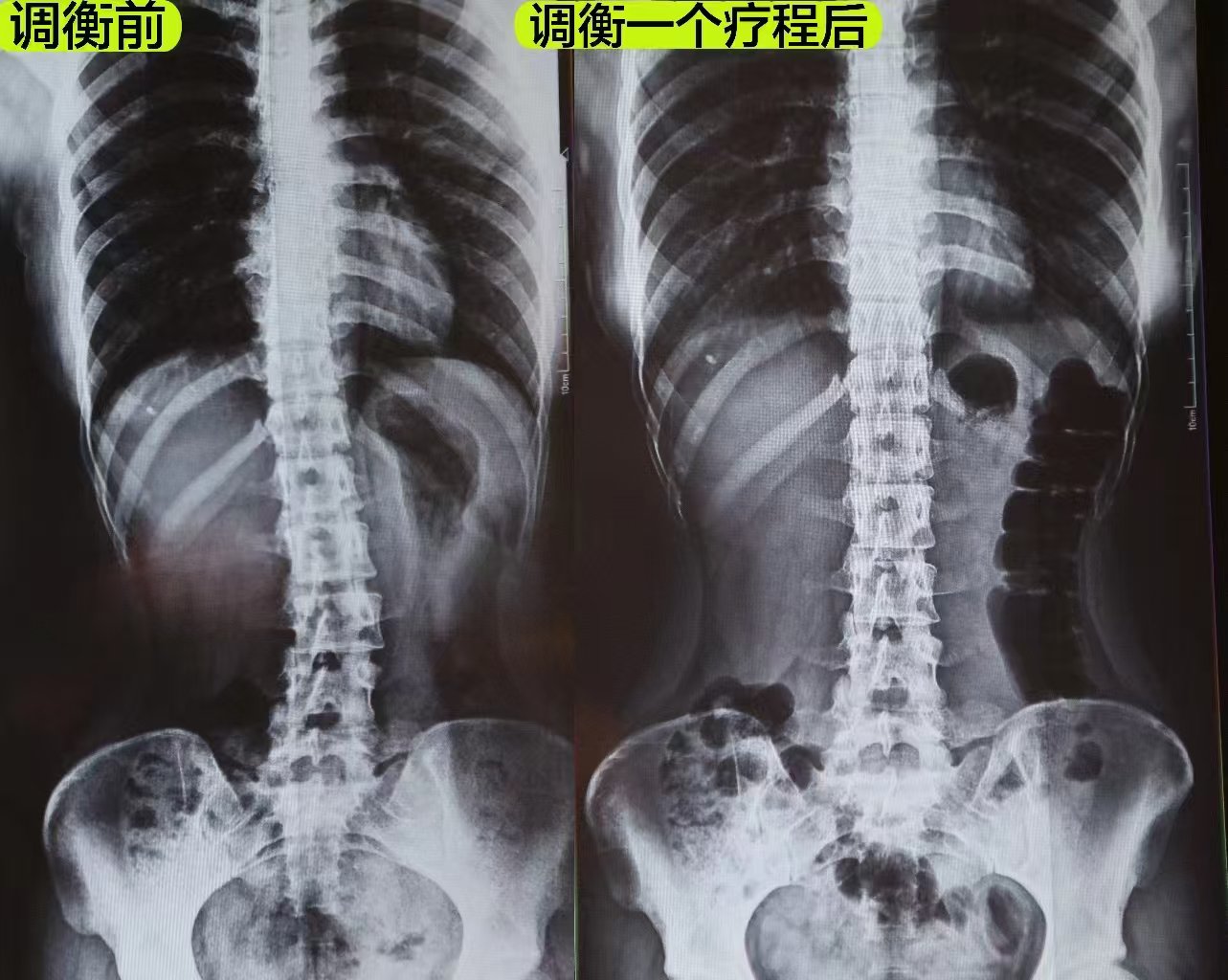 脊柱侧弯调衡前后影像对比图