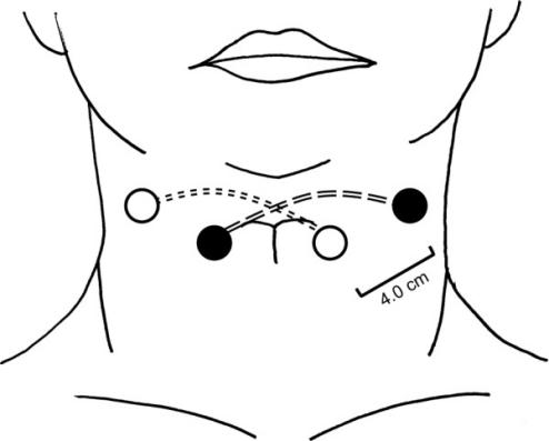 吞咽电疗仪怎么用干扰电疗改善吞咽功能：提升营养摄入与气道保护功能_https://www.jmylbn.com_新闻资讯_第2张