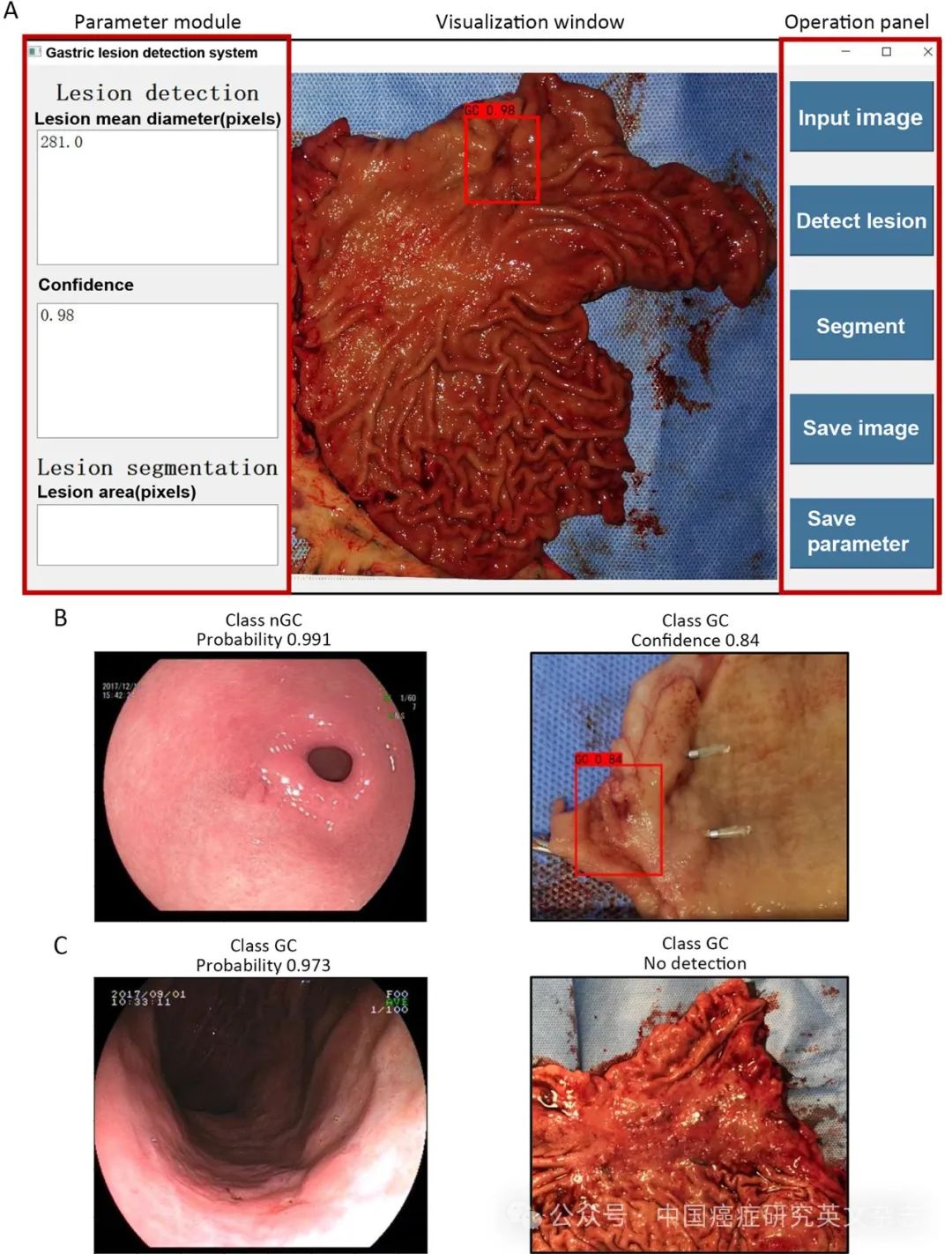 大体标本是什么【论著解读】人工智能看胃镜图片可预判良恶性病变、幽门螺杆菌感染及胃周淋巴结转移_https://www.jmylbn.com_新闻资讯_第10张