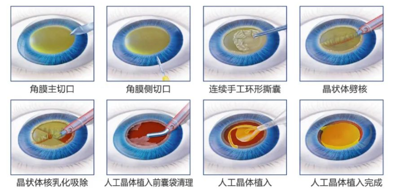 图:白内障手术示意图