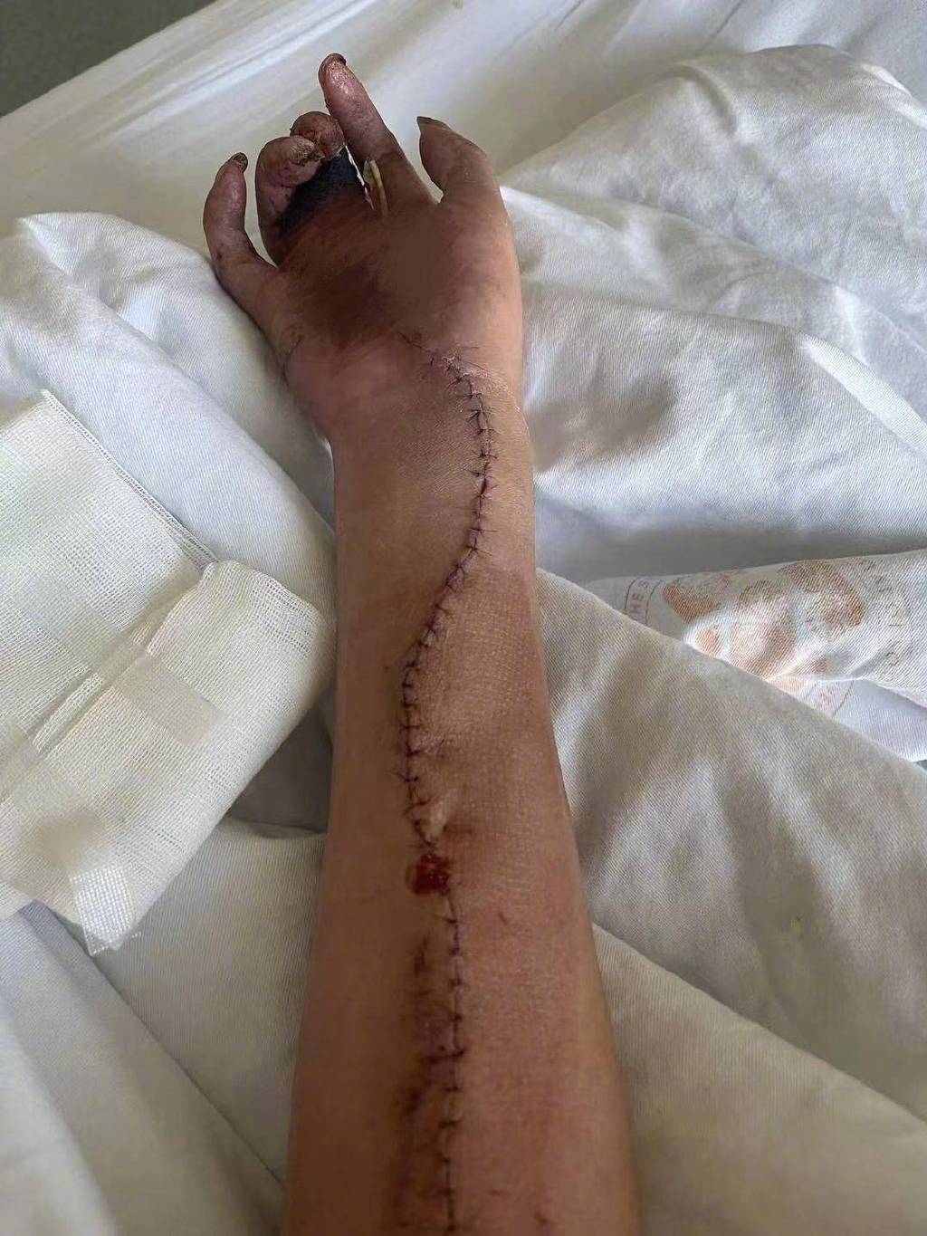小伙上班6天误触辐射源右手截肢:没签劳动合同,没从业资质未受培训