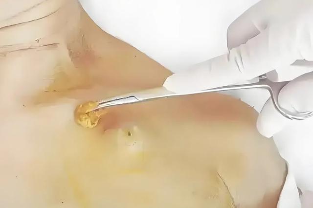 敷料芯是什么一种更“体贴”的输液方式——“输液港”_https://www.jmylbn.com_新闻资讯_第3张