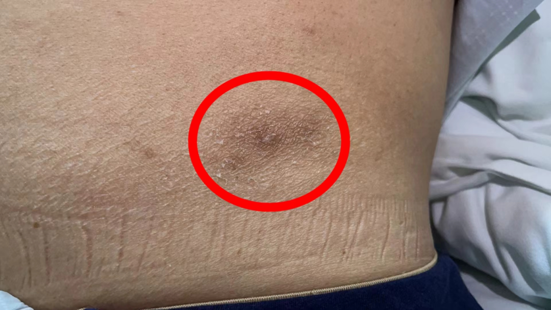 俞大伯被虫子咬伤后留下的伤口