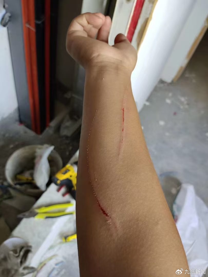 夏天手臂划伤.图/受访者提供