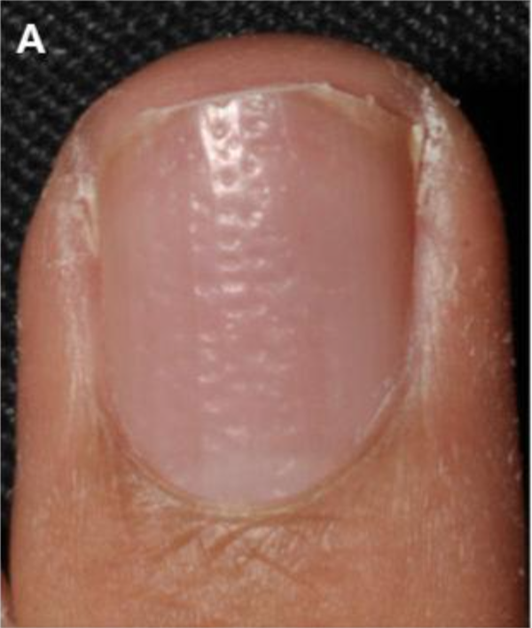 银屑病点凹甲。图片来源：参考文献[7]