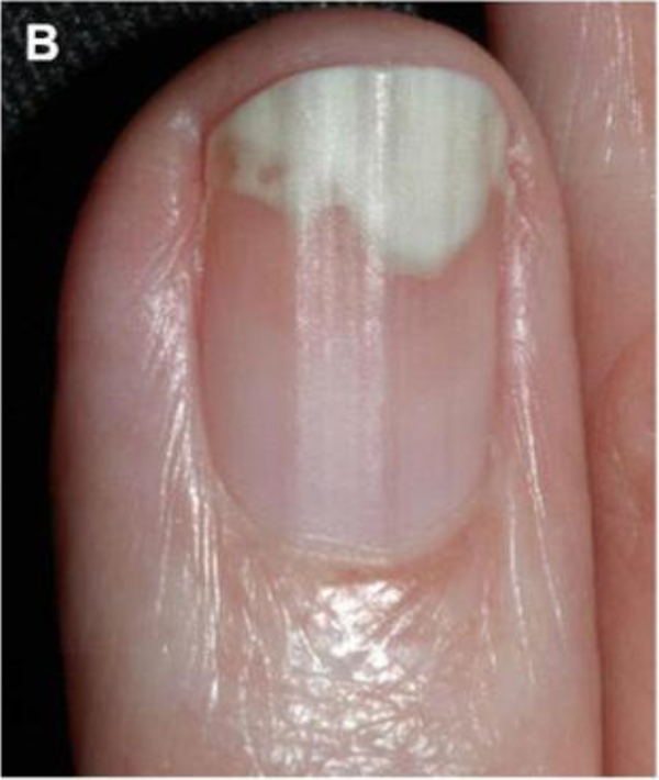 银屑病甲剥离。图片来源：参考文献[7]
