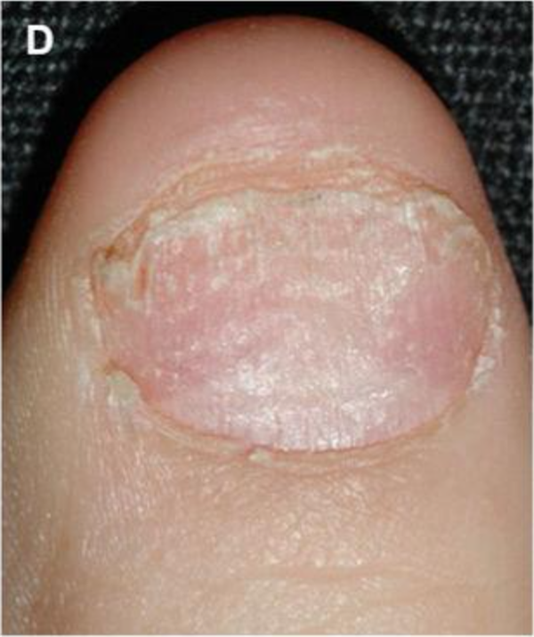 银屑病糙甲。图片来源：参考文献[7]