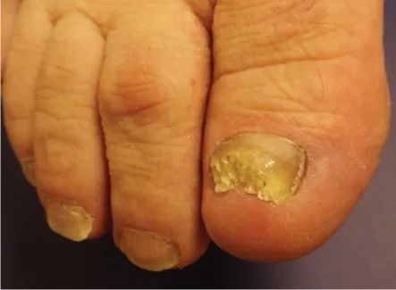 甲真菌病。图片来源：参考文献[6]