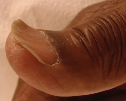 匙状甲。图片来源：参考文献[6]