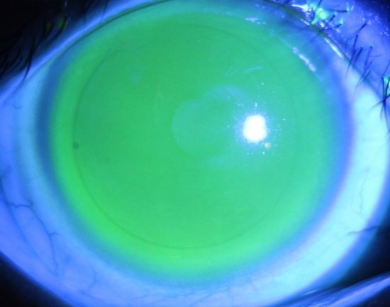 （巩膜镜在眼睛上的状态（染色后）－正常眼）